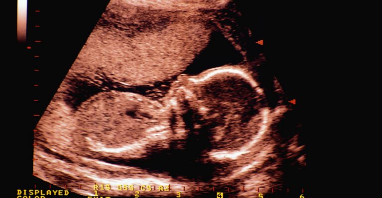 Court Upholds Louisiana Law Requiring Abortion Doctors to Have Admitting Privileges With Nearby Hospitals