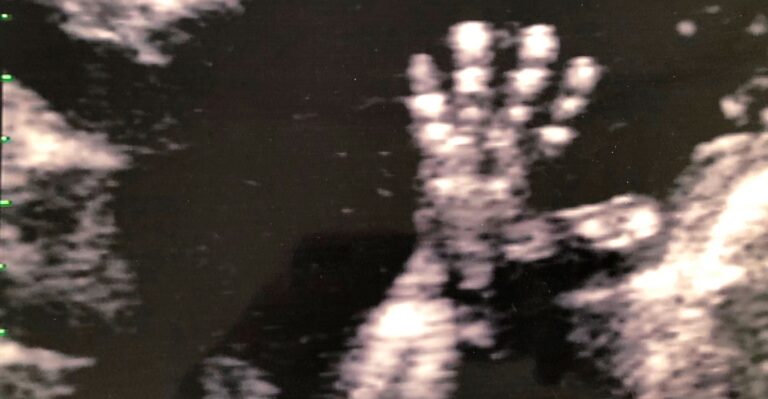 After Roe, Pro-Life Movement’s Just Struggle Shifts to States