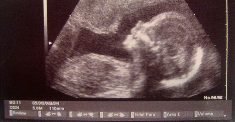 Ohio Bill Would Ban Abortion Based on a Fetal Down Syndrome Diagnosis