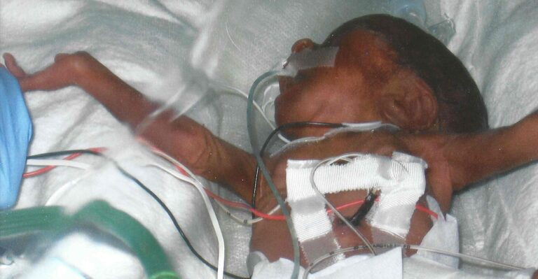 Full Disclosure: Did Government’s Experiment on Preemies Hide Risks?