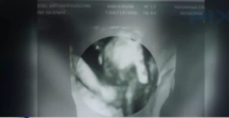 See Unborn Twins Hold Hands as One Faces Death